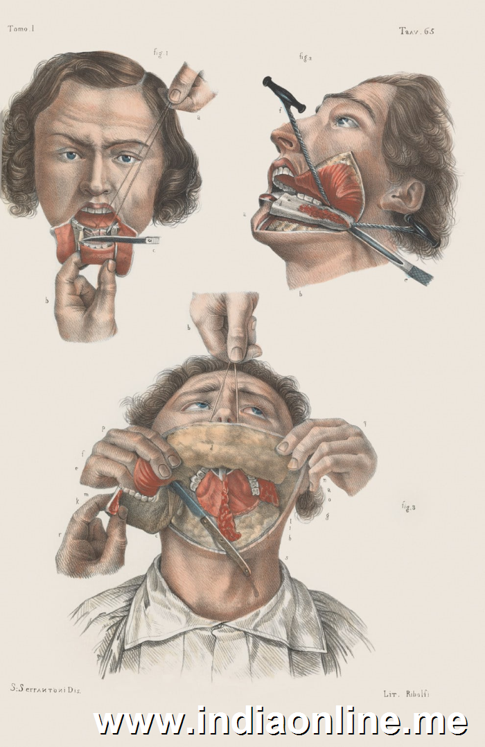 Removal of the lower jaw