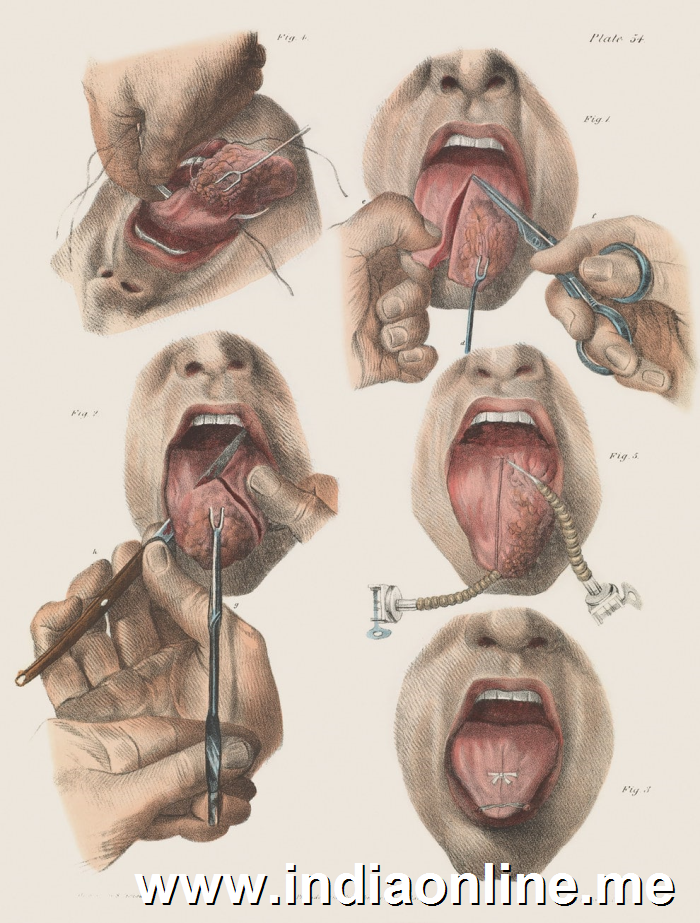 Surgery for tongue cancer.